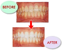 ホワイトニング完了